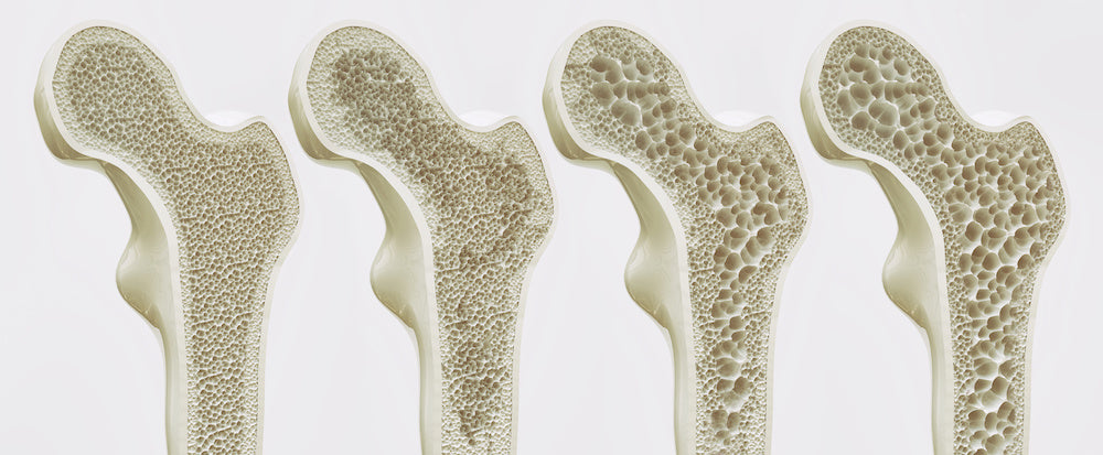 Osteoporose und Wechseljahre